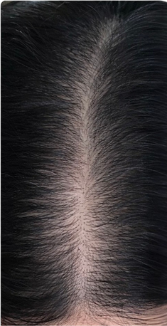 Samira voor gebruik Cirogen