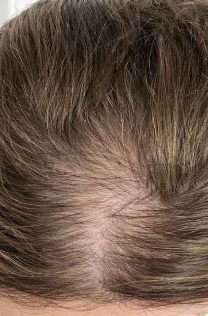 Zoë voor gebruik Cirogen